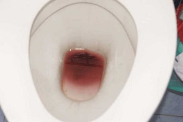 խայտաբղետություն տղամարդկանց մեջ, երբ հուզված է